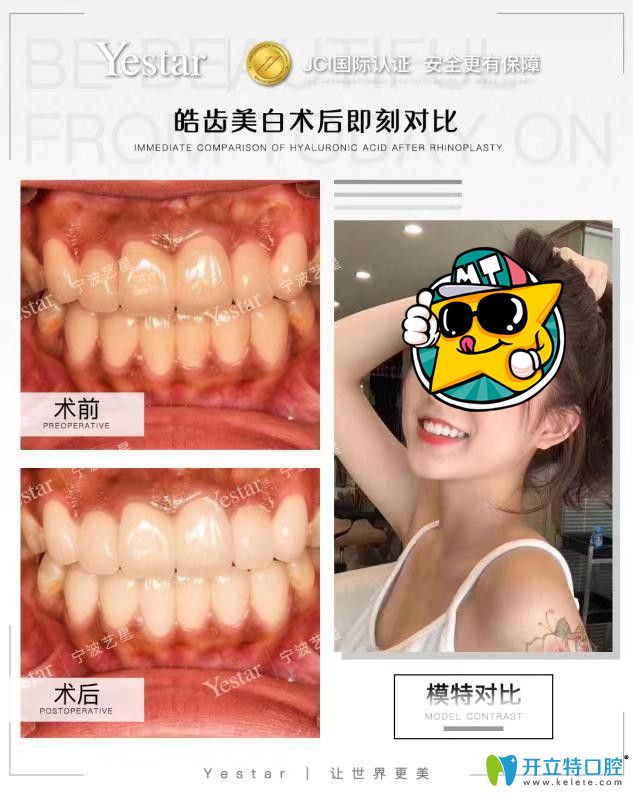 藝星口腔皓齒美白案例前后效果對(duì)比