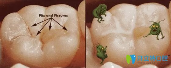 窩溝封閉劑固化后無(wú)毒無(wú)害