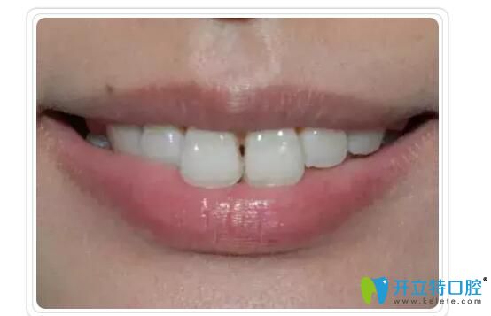 王黨紅主任告訴大家：牙齒矯正回導致“黑三角”是真是假