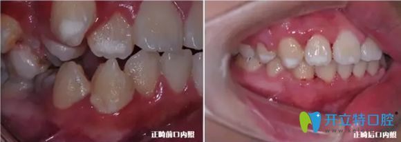 牙齒側(cè)面正畸前后對比效果圖