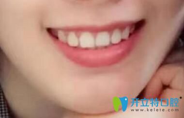 我在深圳諾德齒科做牙齒矯正1年半的效果 我在深圳諾德齒科做牙齒矯正1年半的效果