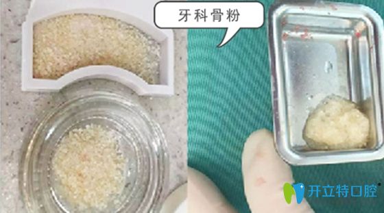 牙科骨粉材料展示圖