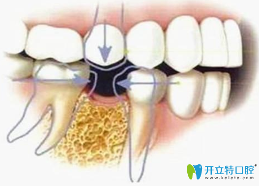 拔除牙根不及時補牙的危害