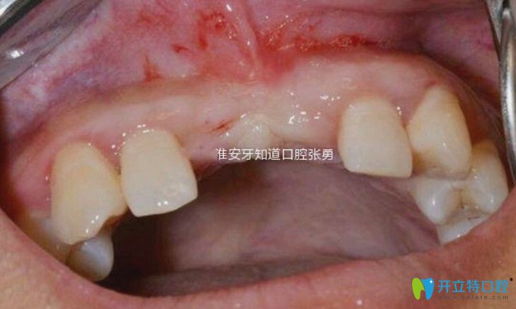 淮安哪里做種植牙好？顧客反饋淮安牙知道張勇種牙水平高
