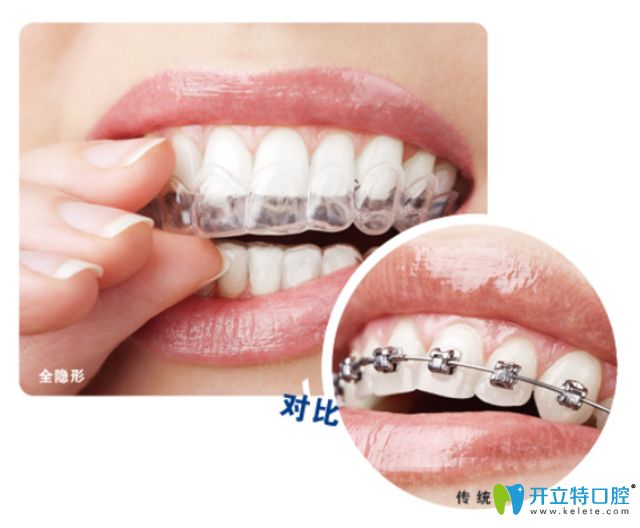靖江艾齒嘉口腔朱彩寅醫(yī)生科普牙齒矯正注意事項(xiàng)