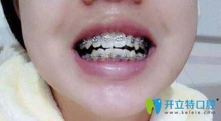 我在石家莊中諾口腔做牙齒矯正1年半