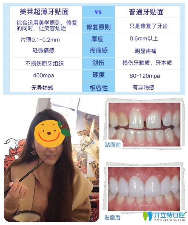 美萊超薄牙貼面你無悔的選擇，小姐姐來曬牙貼面后對比照