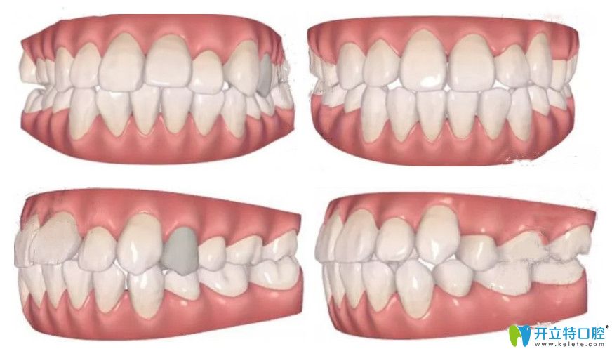 公開(kāi)我的隱適美矯正齙牙記錄！我?guī)а捞?~12月變化圖明顯不