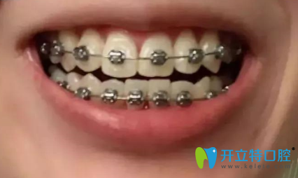 我虎牙外突側(cè)門牙扭轉(zhuǎn)，矯正兩年后的效果