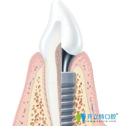 Ankylos種植體對骨的影響狀況