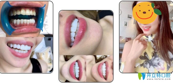 在蘇州康美口腔做了超薄牙貼面前后對(duì)比圖