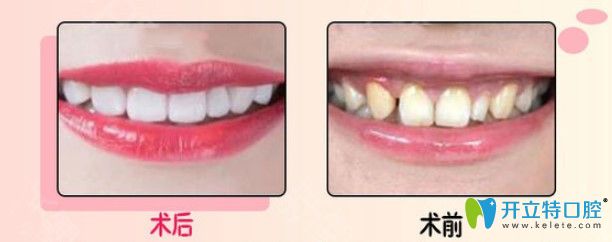 康美超薄牙貼面修復(fù)發(fā)黃牙齒對(duì)比照片