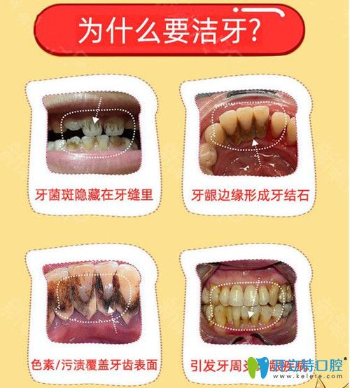為什么要洗牙呢