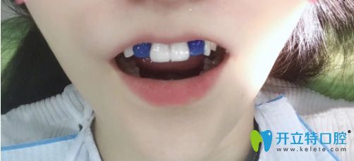 說一說我廣州曙光口腔做完3D數(shù)字全瓷牙貼面的感受及價(jià)格