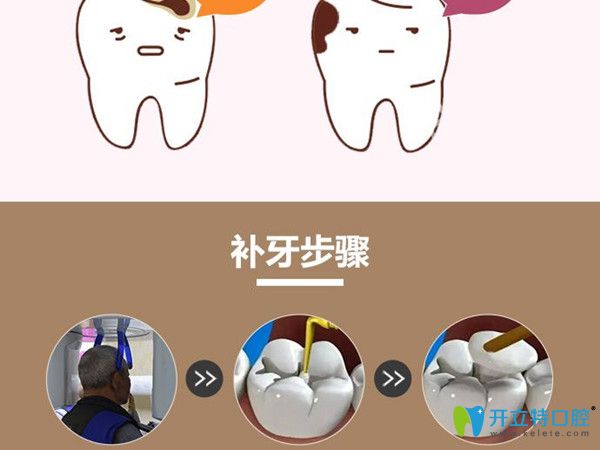 牙醫(yī)解析補(bǔ)牙用什么材料好，選卡瑞斯瑪樹脂補(bǔ)牙還是3m好？