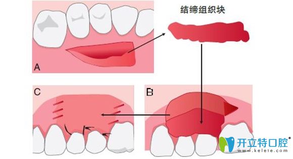 牙齒修補手術過程圖解