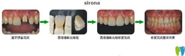 西諾德全瓷牙的制作過程