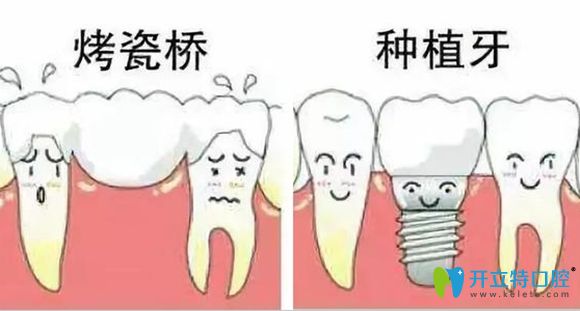 烤瓷牙和種植牙修復示意圖