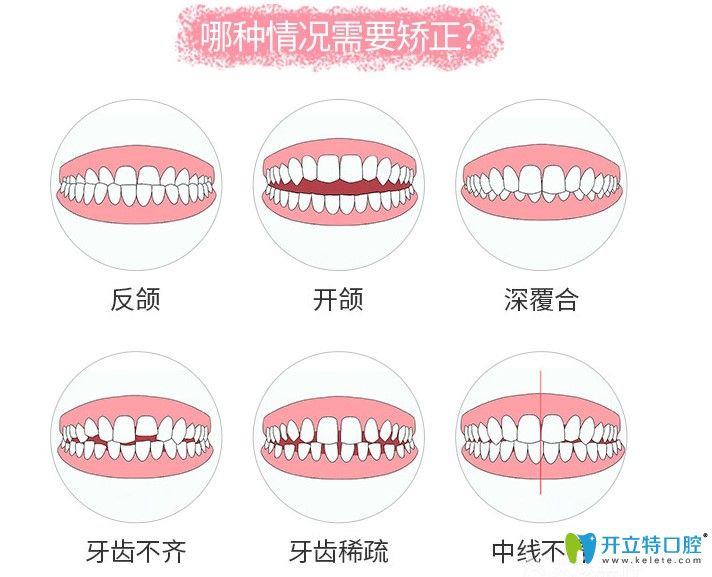 哪些牙齒畸形要進(jìn)行牙齒矯正