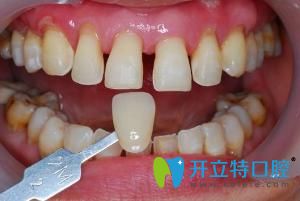 上海牙齒貼片多少錢?精心整理牙貼面價格含樹脂瓷貼面區(qū)別