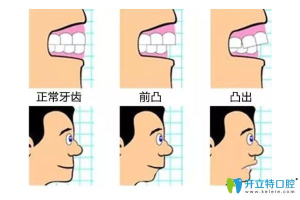牙齒不同程度矯正后對(duì)比圖