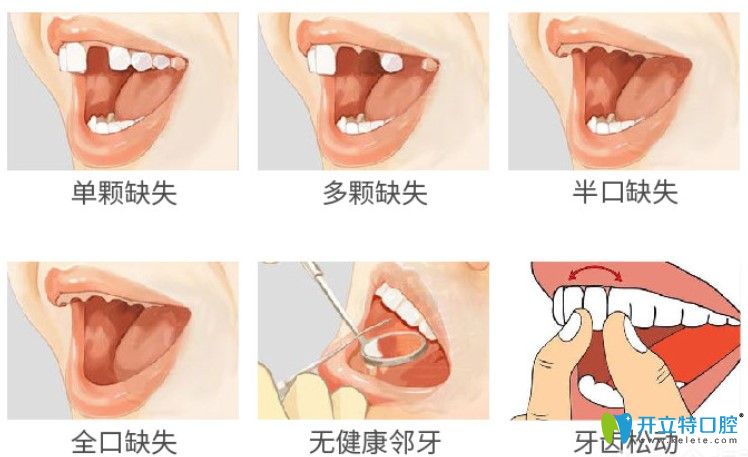 瑞士iti種植牙的優(yōu)勢