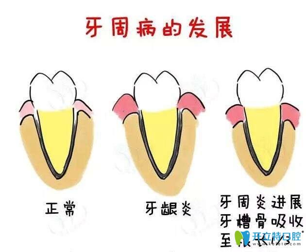 牙周病發(fā)展歷程