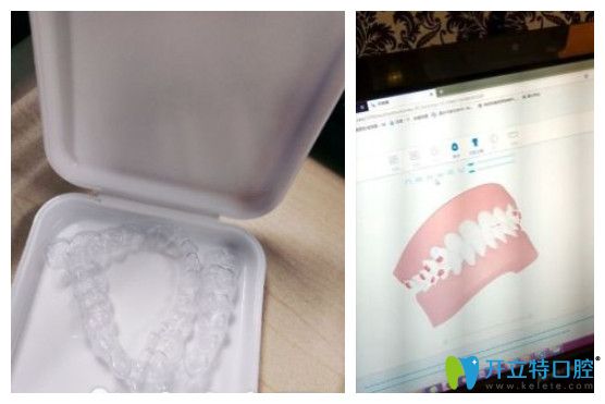 北京美萊牙齒矯正怎么樣?來自小姐姐們真實(shí)正畸感受分享