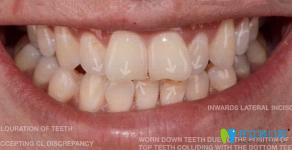 曬北京美萊戴金屬牙套矯正前后對比照,并說下摘牙套的感覺