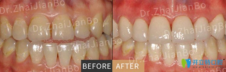 超薄瓷貼面美牙前后對比圖片