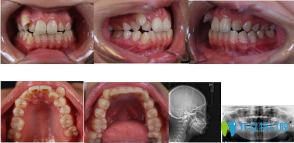 網(wǎng)紅小哥哥在佳美口腔矯正前的牙齒照