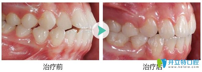 <!--<i data=20240703-sp></i>-->口腔隱適美齙牙矯正前后對比效果圖