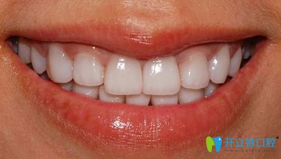 在合肥壹加壹口腔做完正畸和牙齒貼面的術(shù)后效果