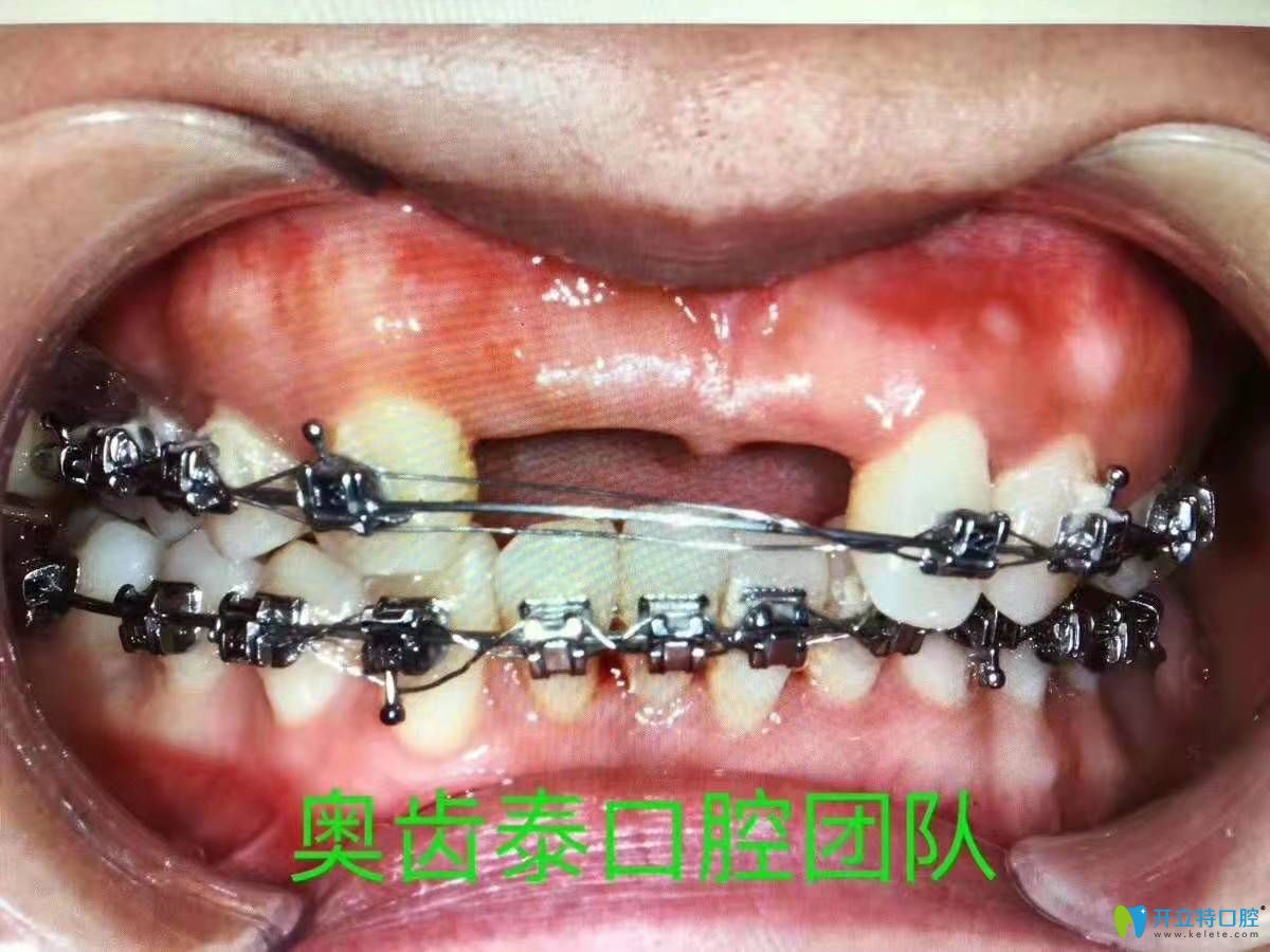 溫州奧齒泰口腔門診部牙周炎金屬自鎖托槽矯正
