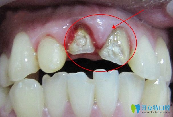 全瓷牙基牙發(fā)生根尖炎也會(huì)引起吃東西疼痛