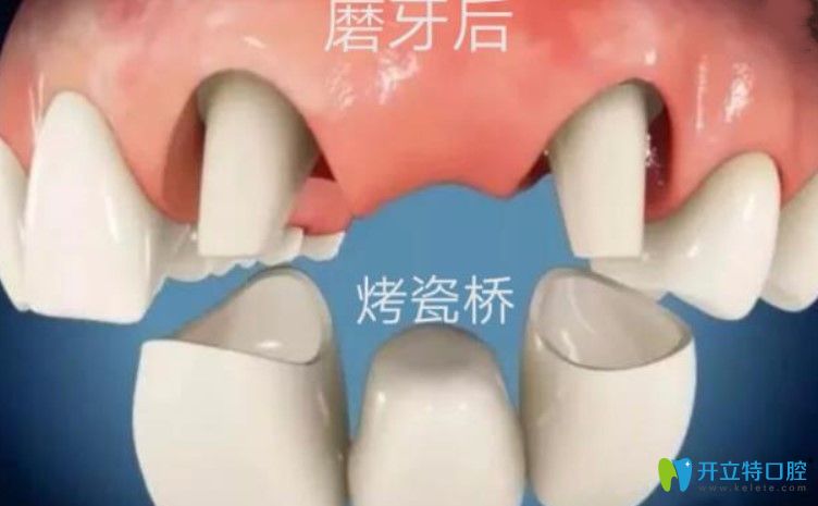 剛戴上全瓷牙咬東西疼是咋回事？趕緊戳進(jìn)來看看吧