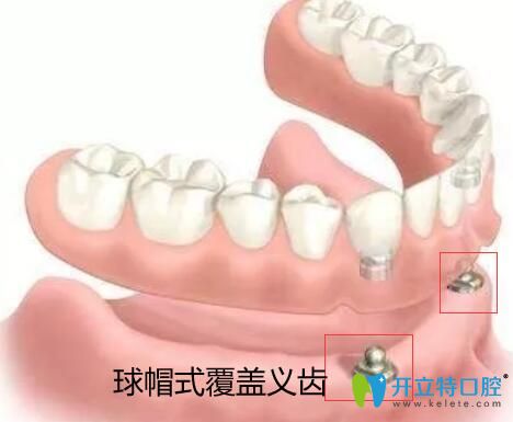 價格吊打種植牙的全口覆蓋義齒修復(fù)到底有哪些優(yōu)缺點(diǎn)？