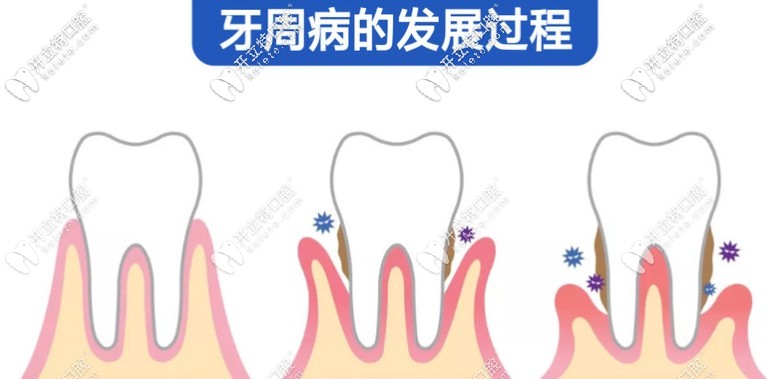 齦下刮治疼嗎