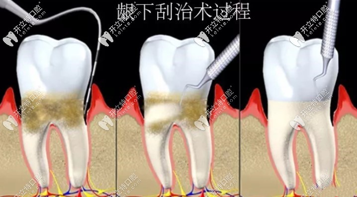 為啥有人說齦下刮治后悔死了,難道是因為有啥副作用嗎？