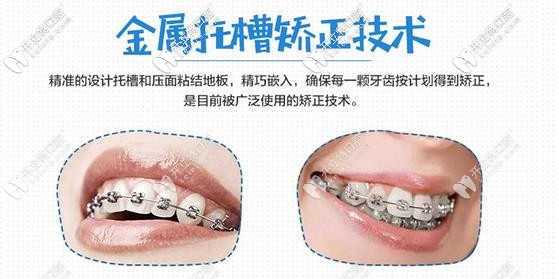 金屬托槽矯正技術(shù)