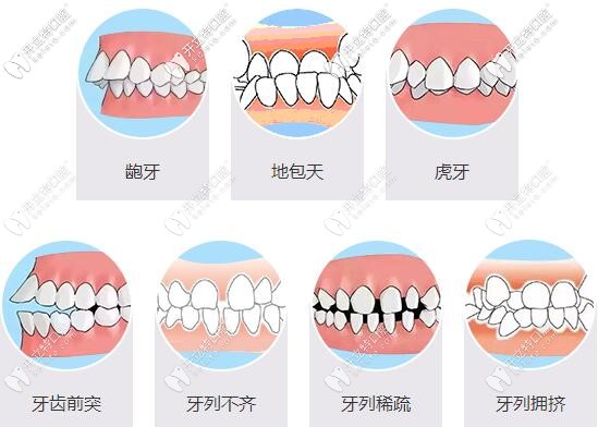 牙齒畸形對我們的影響很大