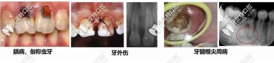 常見的牙體牙髓疾病