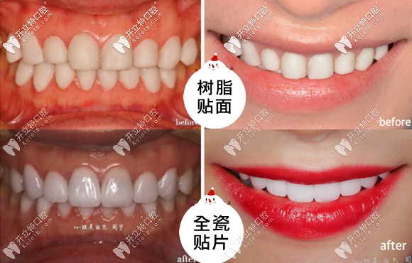 樹脂貼面和全瓷貼面的效果對比