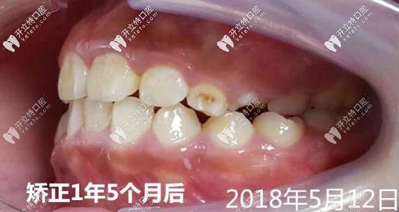 孩子牙列畸形做矯正后的照片