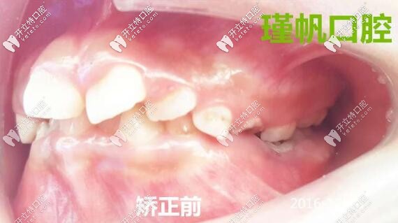 牙齒畸形矯正前側面照片