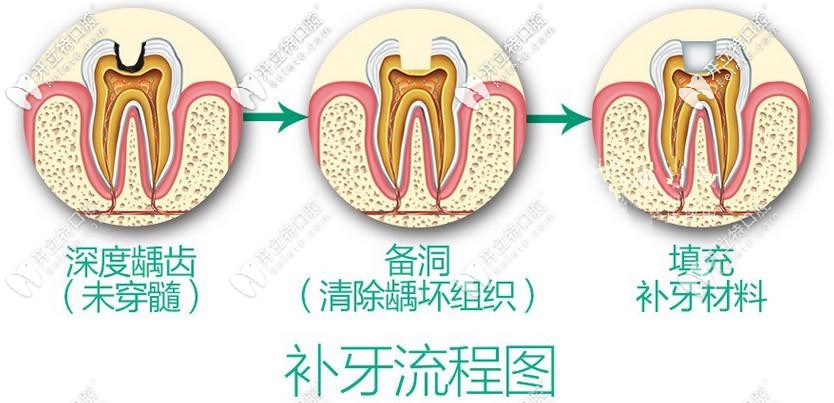 補(bǔ)牙攻略：3m和德國voco納米樹脂補(bǔ)牙哪個材料更好？