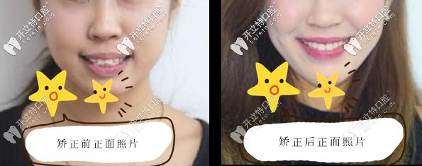 凸嘴戴隱適美牙套前后正面變化照片