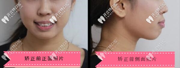隱適美牙套解決了我的凸嘴,拿著齙牙矯正前后對(duì)比照得瑟下!