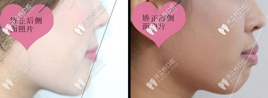 齙牙矯正前后側面對比照片