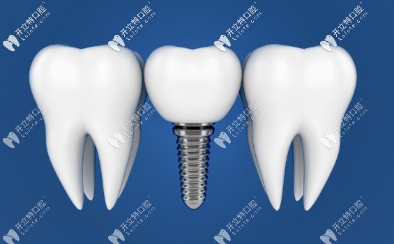 沈陽(yáng)米蘭齒科種植體特點(diǎn)